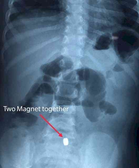 Doctors at Sakra World Hospital removed swallowed magnets from a 2-year-old