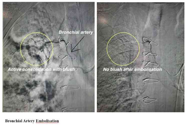 Christian Medical College and Hospital adds newer treatments in neuro and vascular intervention 