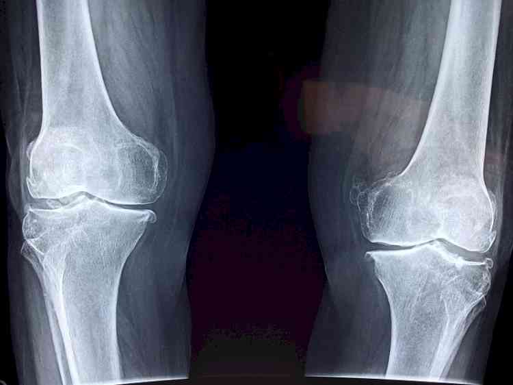 Knee replacement surgeries fell 40% in India due to Covid: Experts