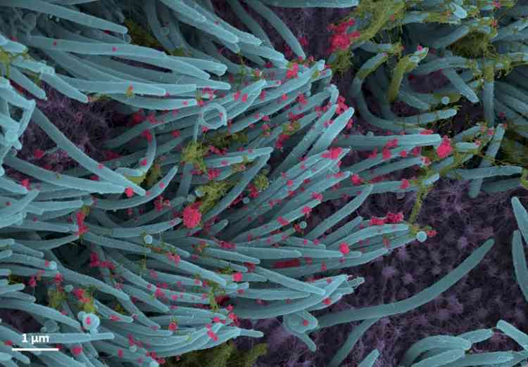 Covid infects kidneys and leads to scarring: Study