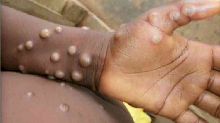 Monkeypox cases confirmed in 12 countries