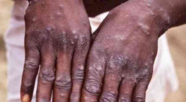 Canada confirms 10 additional cases of monkeypox