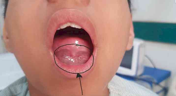 11-year-old-boy with mass under tongue treated successfully at Ivy