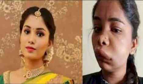 Kannada actress Swathi's face gets horribly swollen after root canal op goes wrong