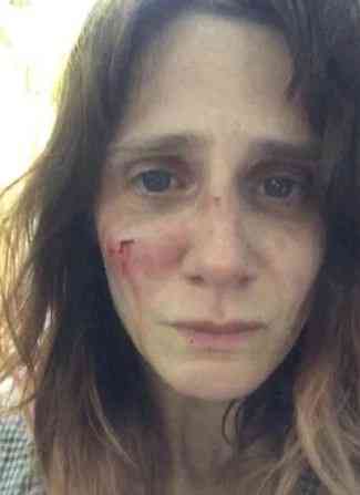 Victim of domestic abuse, French actress posts shocking pics on Instagram