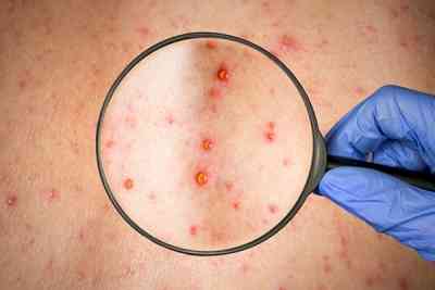 How chickenpox virus is linked to onset of Alzheimer's disease