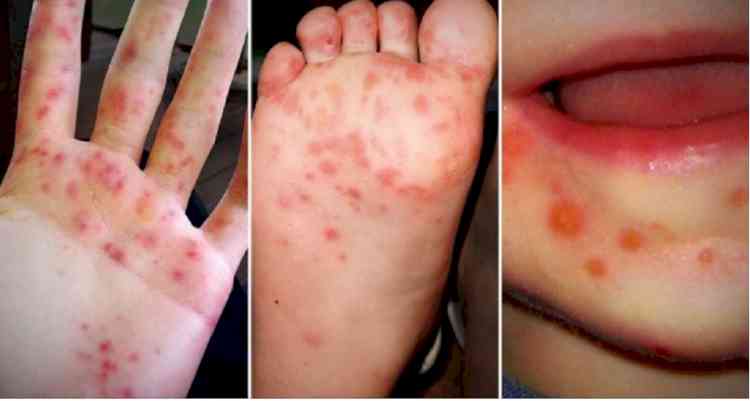 An information about monsoon’s viral infections among children