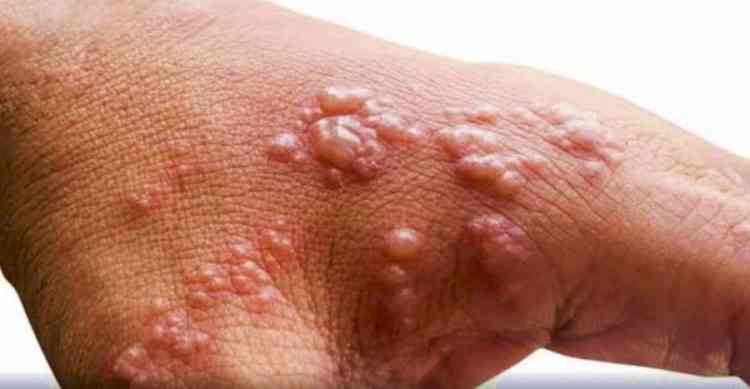 Suspected monkey pox case reported in Rajasthan