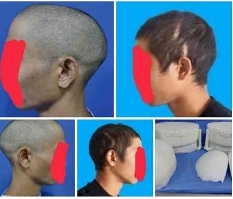 Doctors at Sakra World Hospital corrects 27-year-old’s Head Deformity with Cranioplasty