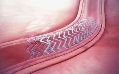 PGI Chandigarh performs first robotically assisted bioresorbable stent implantation