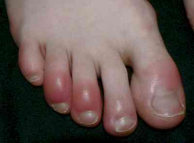 Swelling in feet could be signs of kidney trouble
