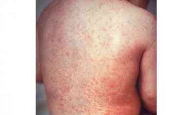 Measles cases rising again globally: Report