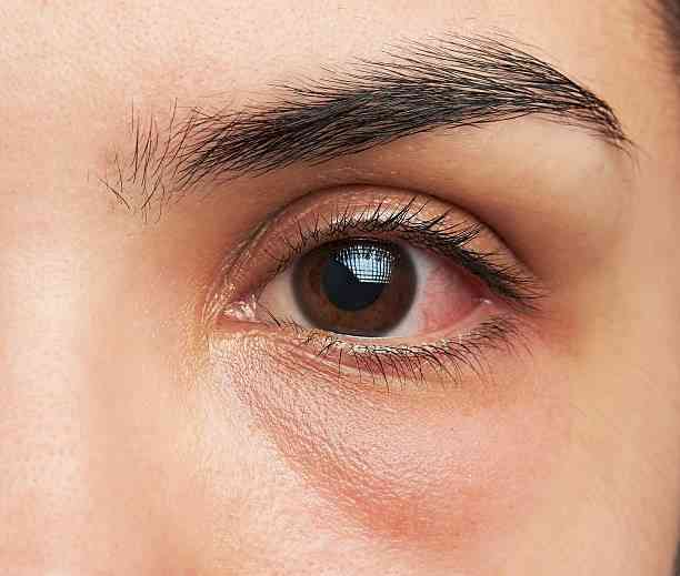 Mumbai Braces for Rising Conjunctivitis Cases This Rainy Season