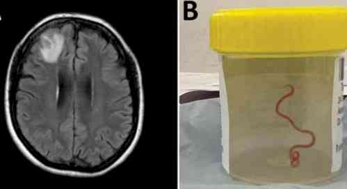 8-cm live worm removed from woman's brain in world's 1st discovery