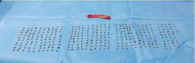 Surgical Milestone: Surgeons at Aster RV Hospitals Achieve Milestone with Removal of 345 Gallstones