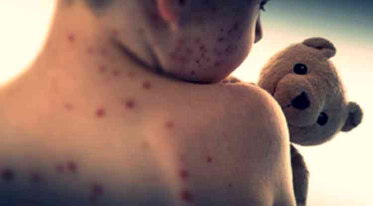 Covid has increased risk of measles, brain disorder