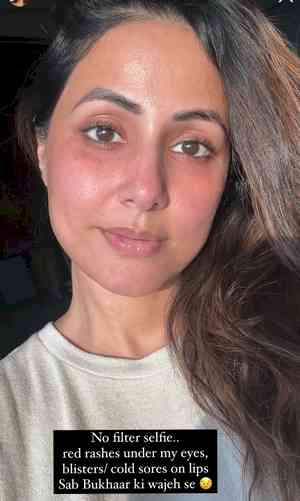 Hina Khan shares raw no-filter selfie with red rashes, blisters on lips