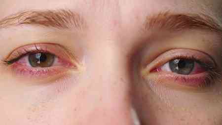 City doctors report 50 pc rise in eye problems as smog continues to engulf Delhi