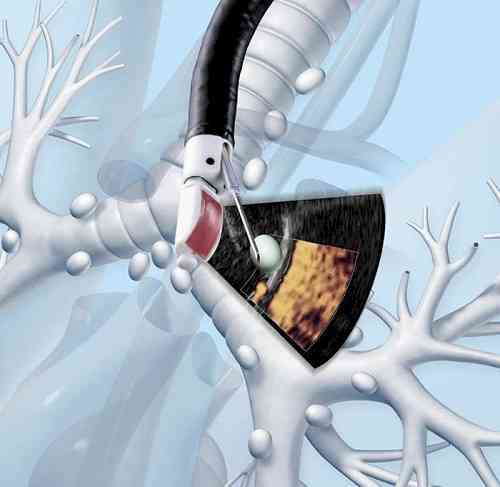 Livasa Hospital, Amritsar introduces next-generation EBUS-FNA for early detection of complex chest diseases