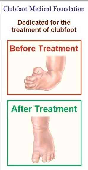 Sahyadri Hospitals Drives Awareness on Effective Clubfoot Treatment Options